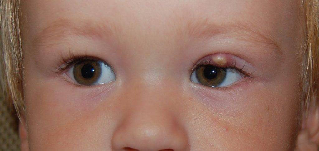 Как лечить ячмень у ребенка на глазу