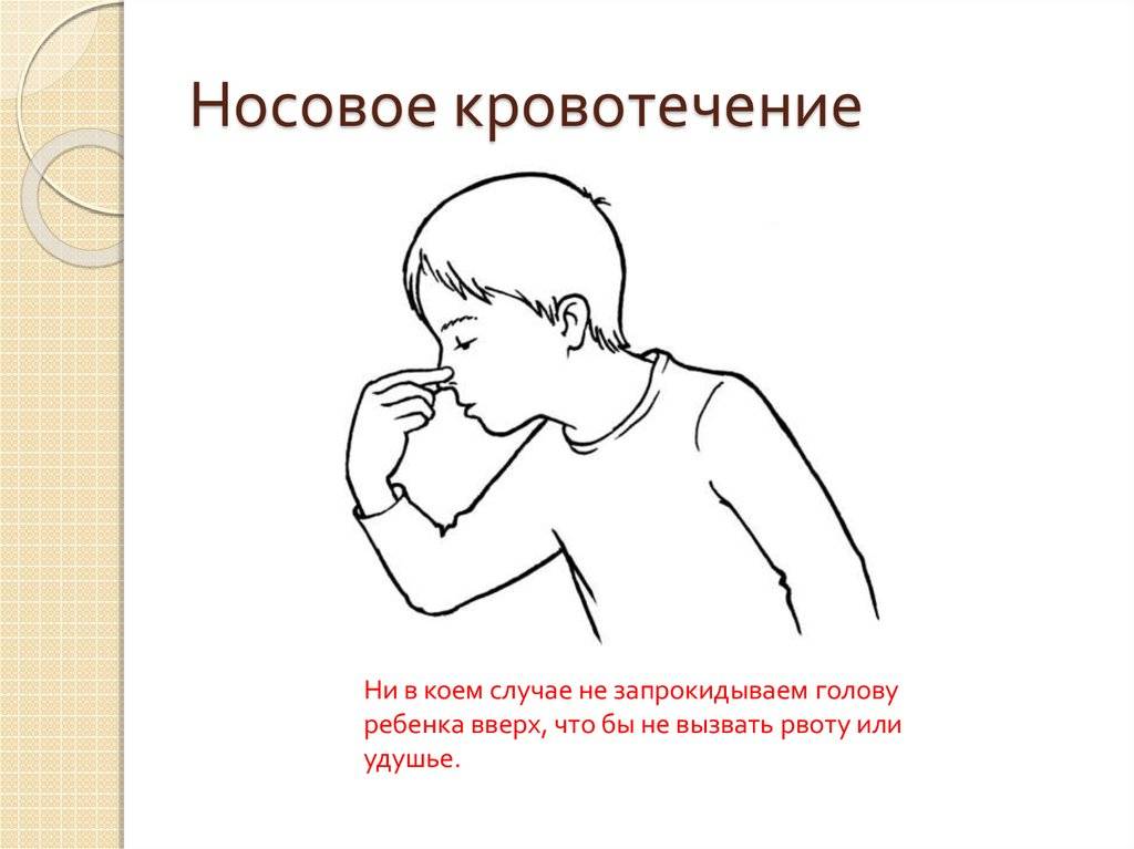 Почему идет кровь из носа у ребенка и как остановить кровотечение из носа. носовое кровотечение у ребенка