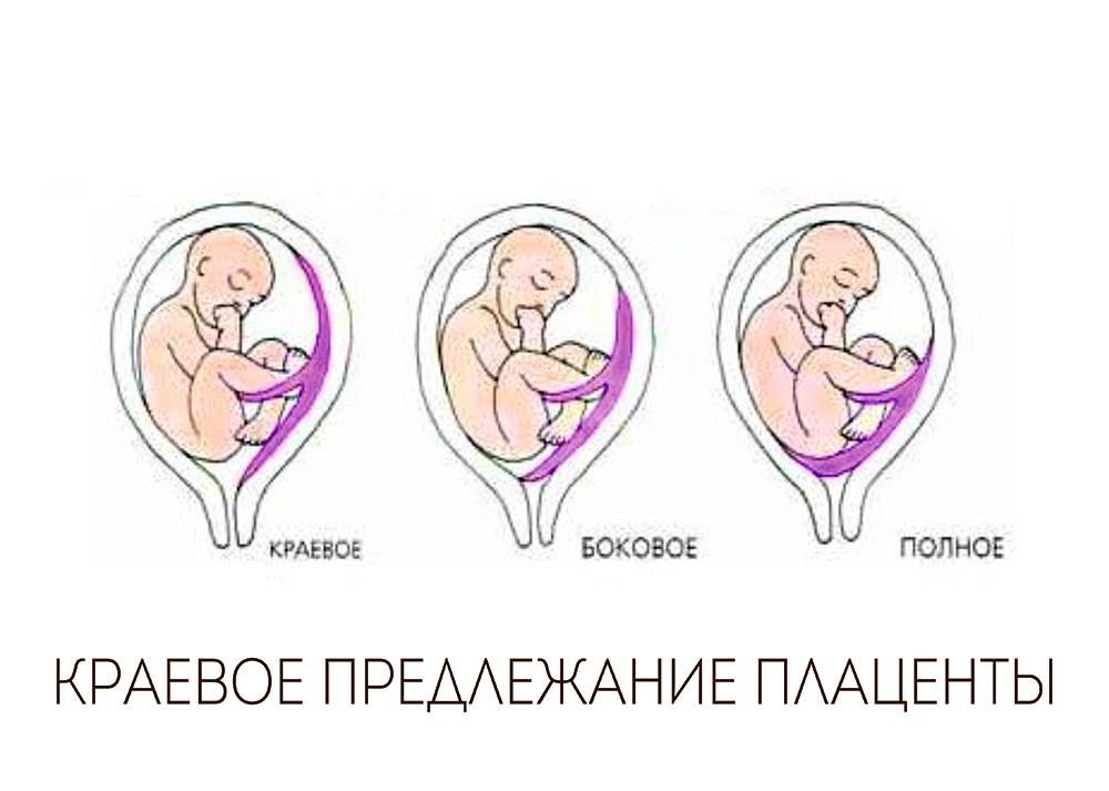 Предлежание плаценты: «безвыходная» беременность