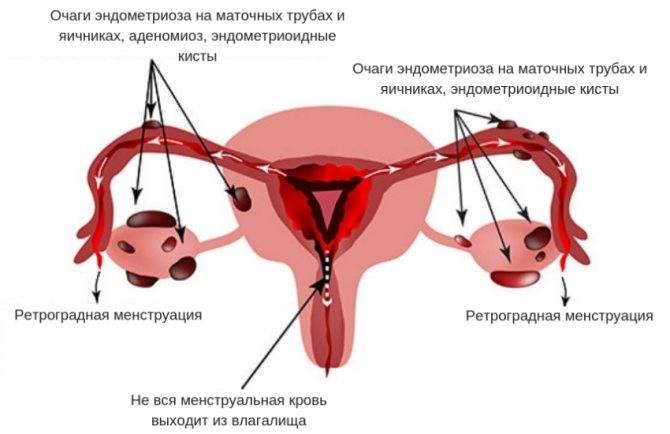 Аденомиоз и беременность: совместимы ли эти состояния