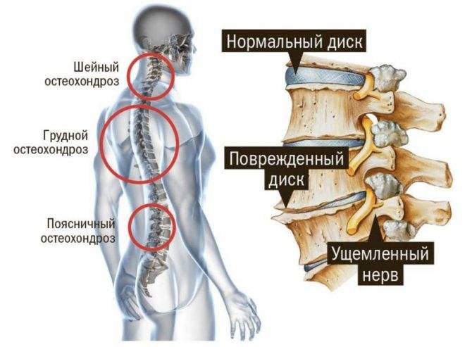 Остеохондроз шейного отдела позвоночника: что это такое, причины, симптомы и способы лечения - московский центр остеопатии