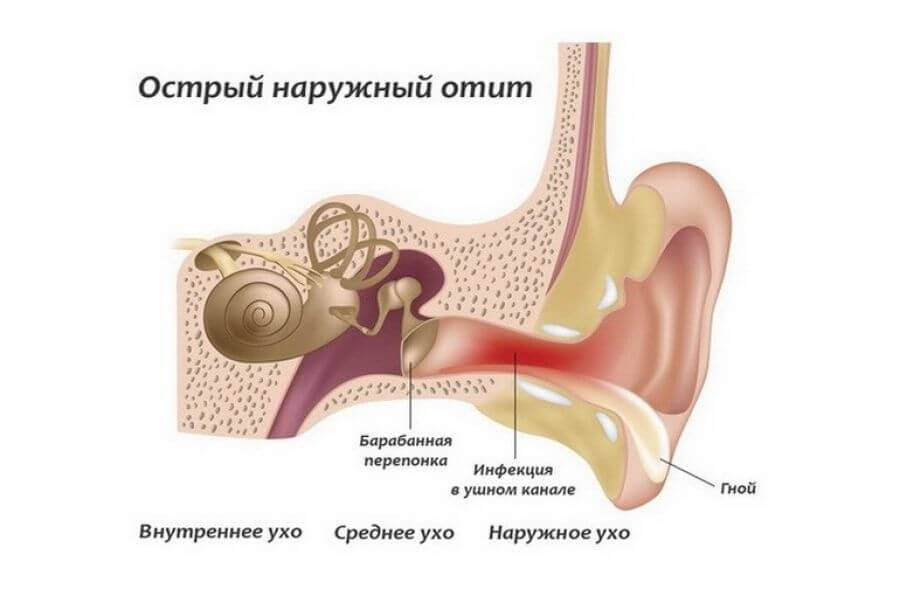 Симптомы отита у грудничка — как понять что у ребенка болит ухо?