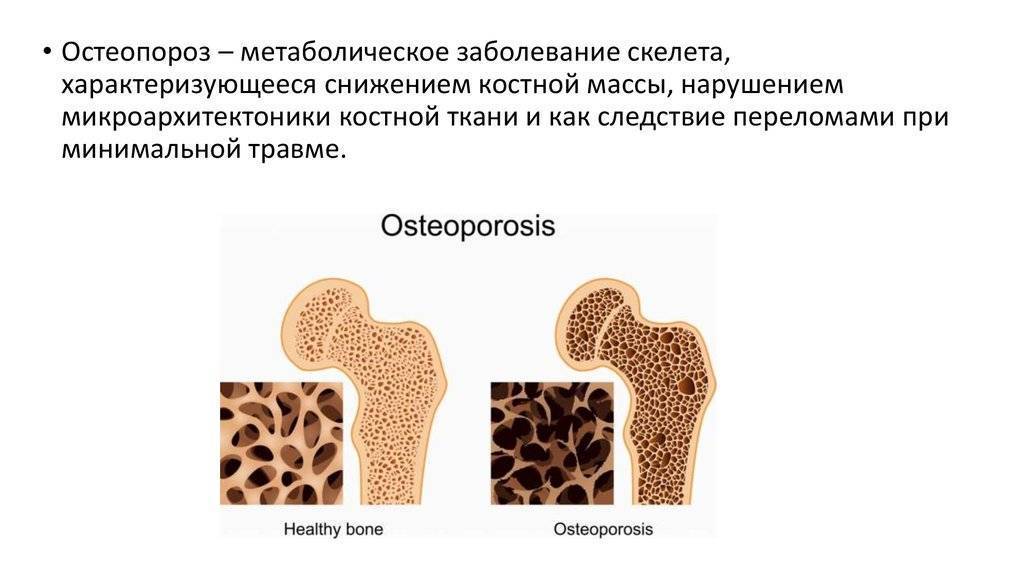 Остеопороз 1, 2, 3, 4 степени: симптомы, лечение