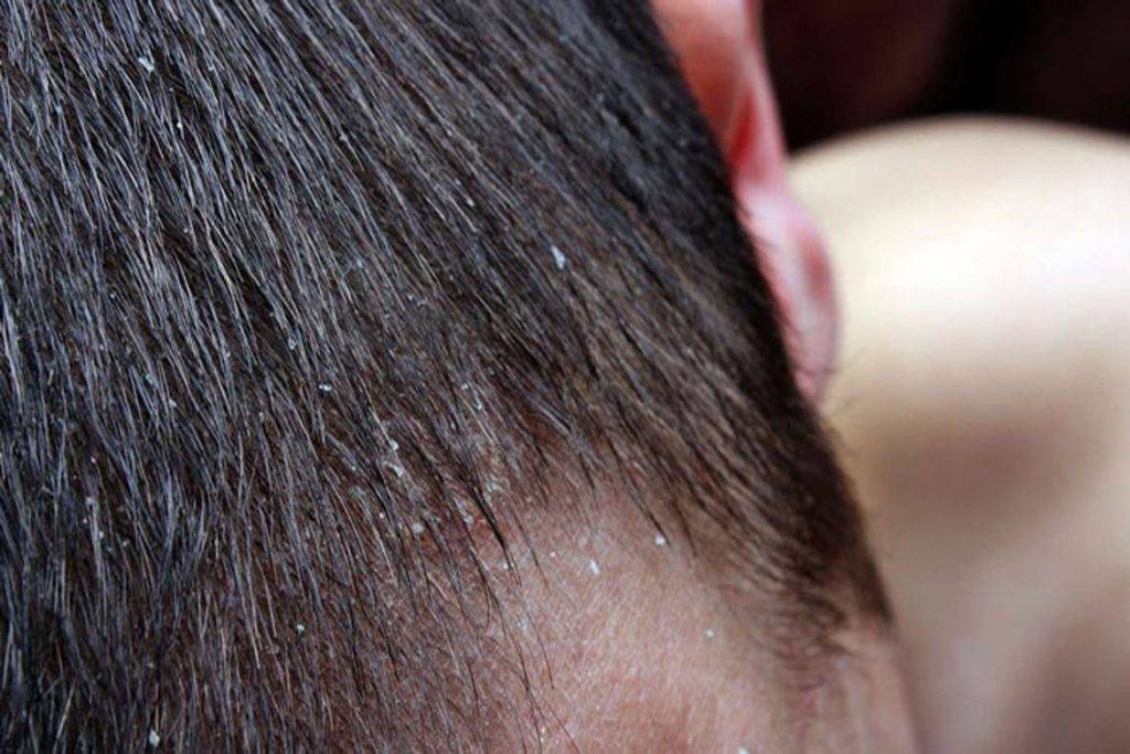 Сухость кожи головы у ребенка: симптомы и лечение - medical insider