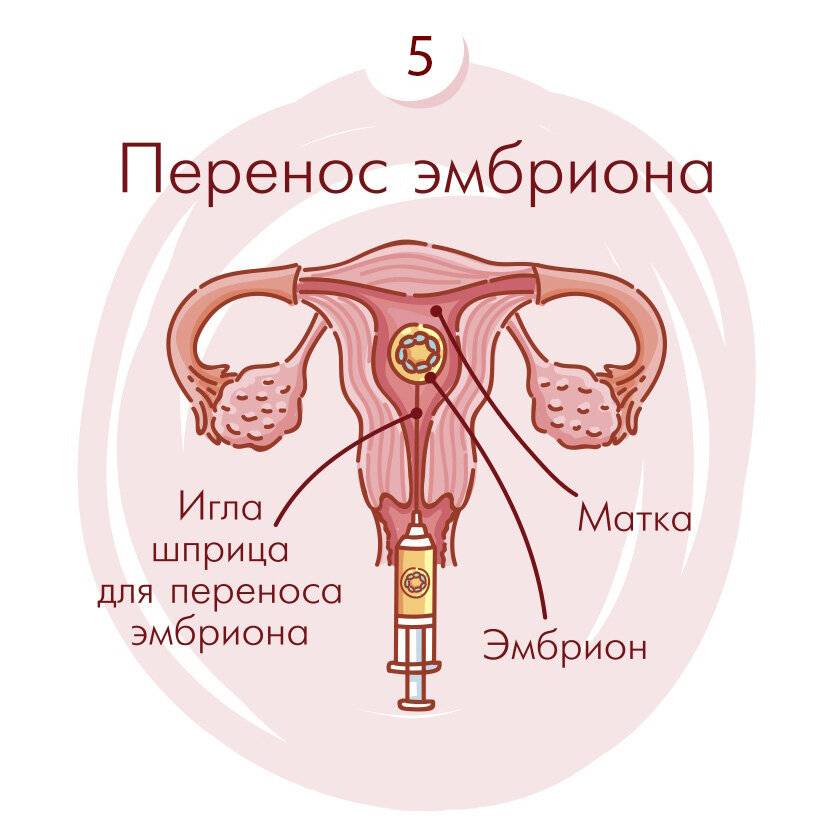5 день после переноса эмбрионов
