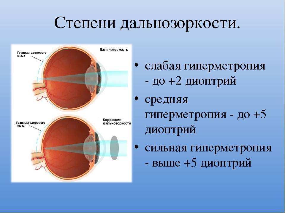 Миопический астигматизм обоих глаз, лечение сложного миопическиого астигматизма в клинике fedorovmedcenter.ru