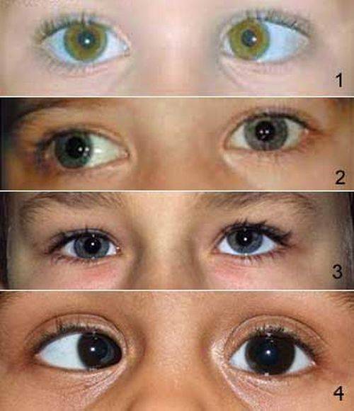 Психосоматика близорукости, дальнозоркости и других глазных болезней