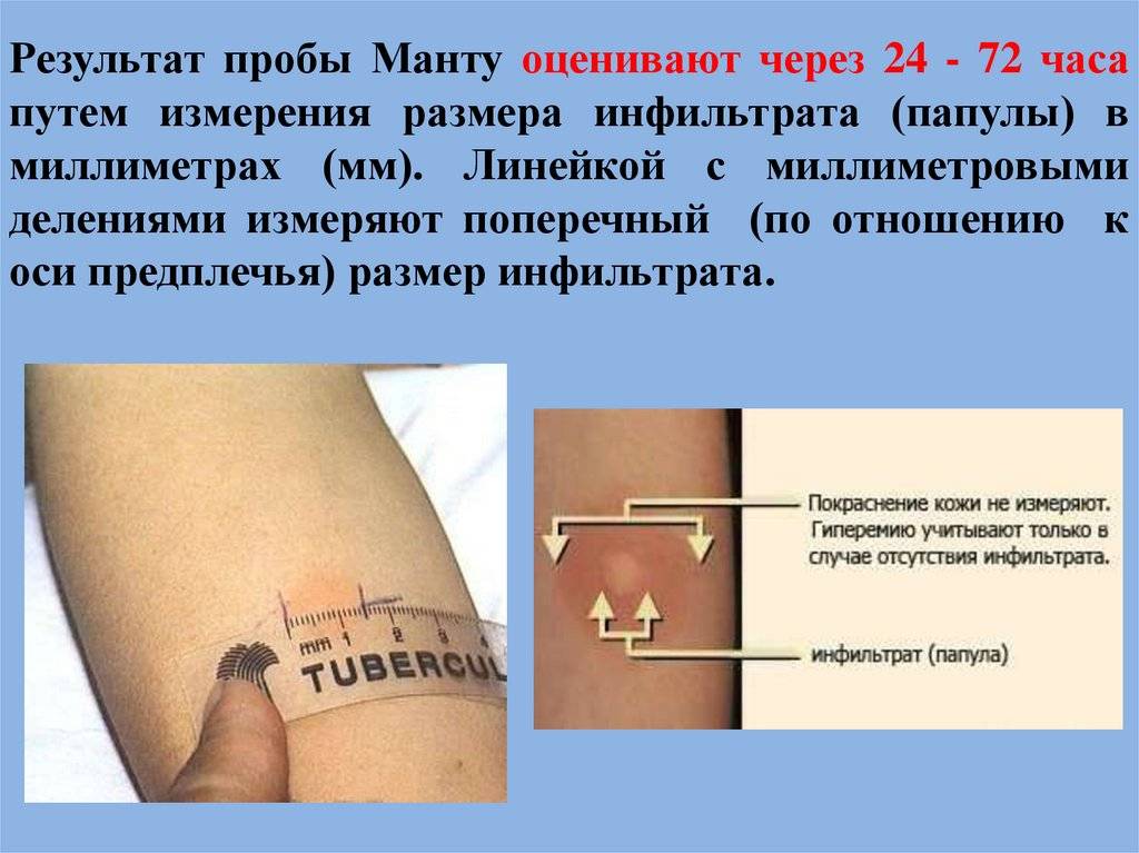 » что такое реакция манту и прививка бцж?