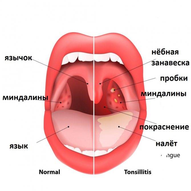Виды ангины