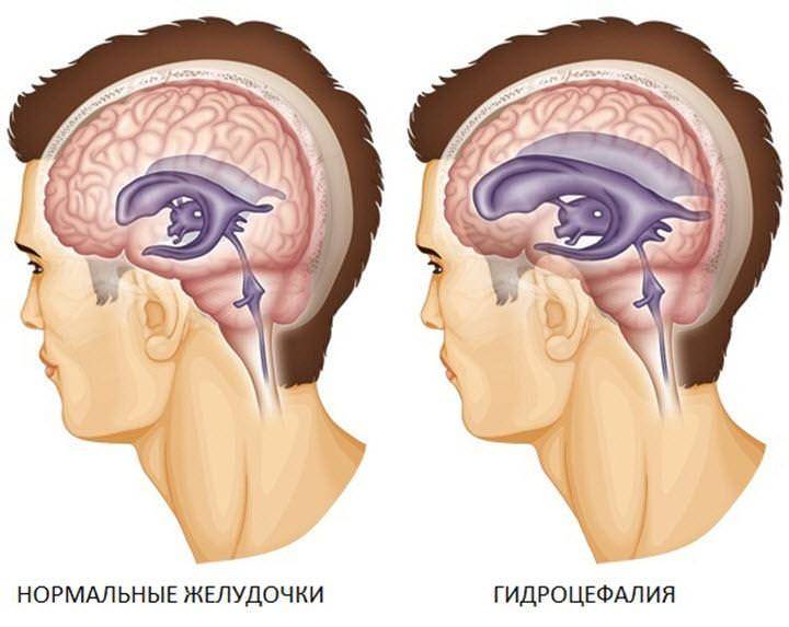 Что такое гидроцефалия? – медицинский центр «нейросонография»