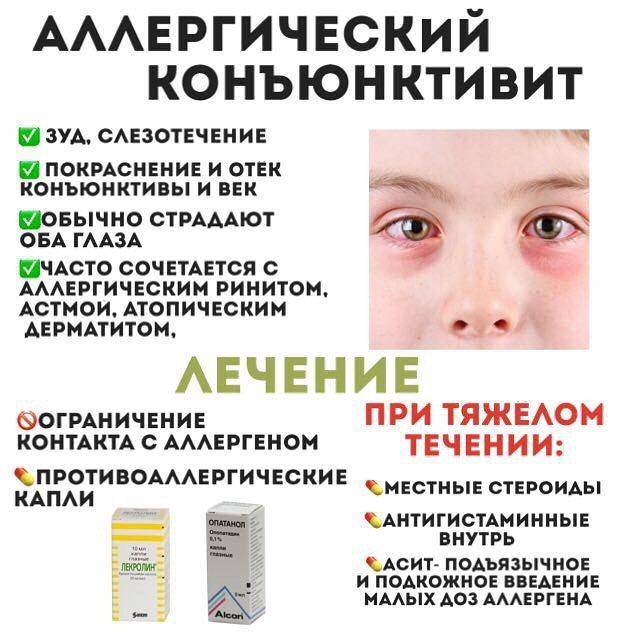 Каковы причины конъюнктивита у младенца и как его лечить? - энциклопедия ochkov.net