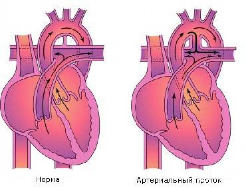 Кт и мрт диагностика дефекта межжелудочковой перегородки сердца у детей