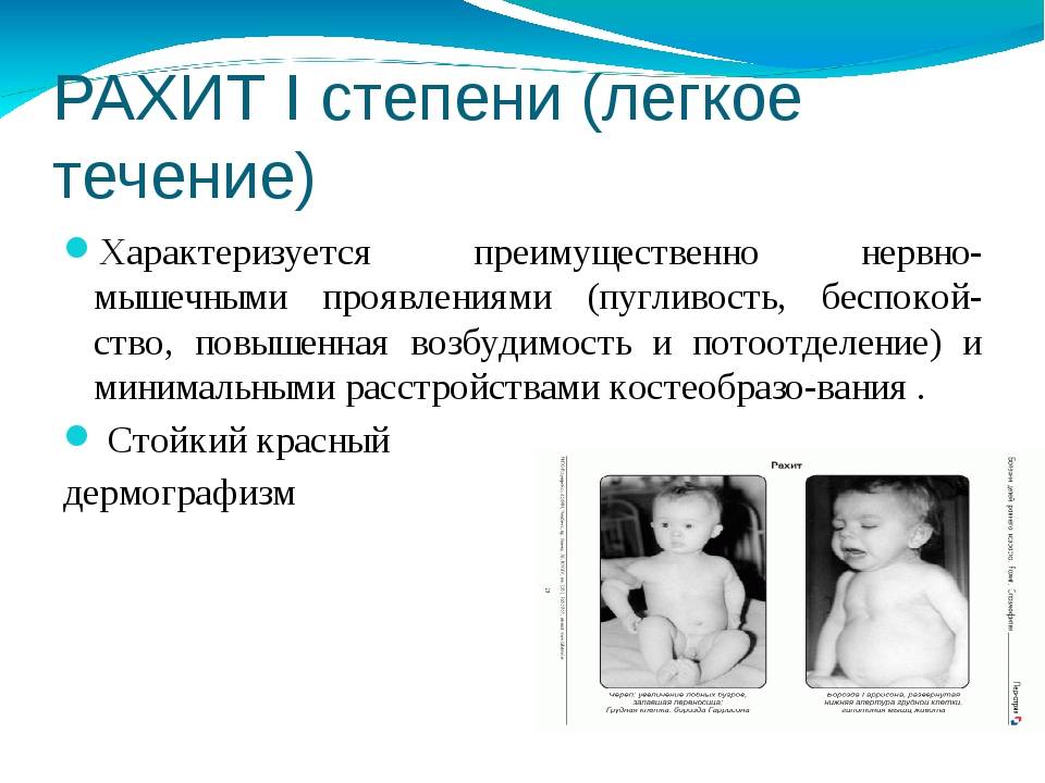 Рахит у ребенка. лечение и профилактика