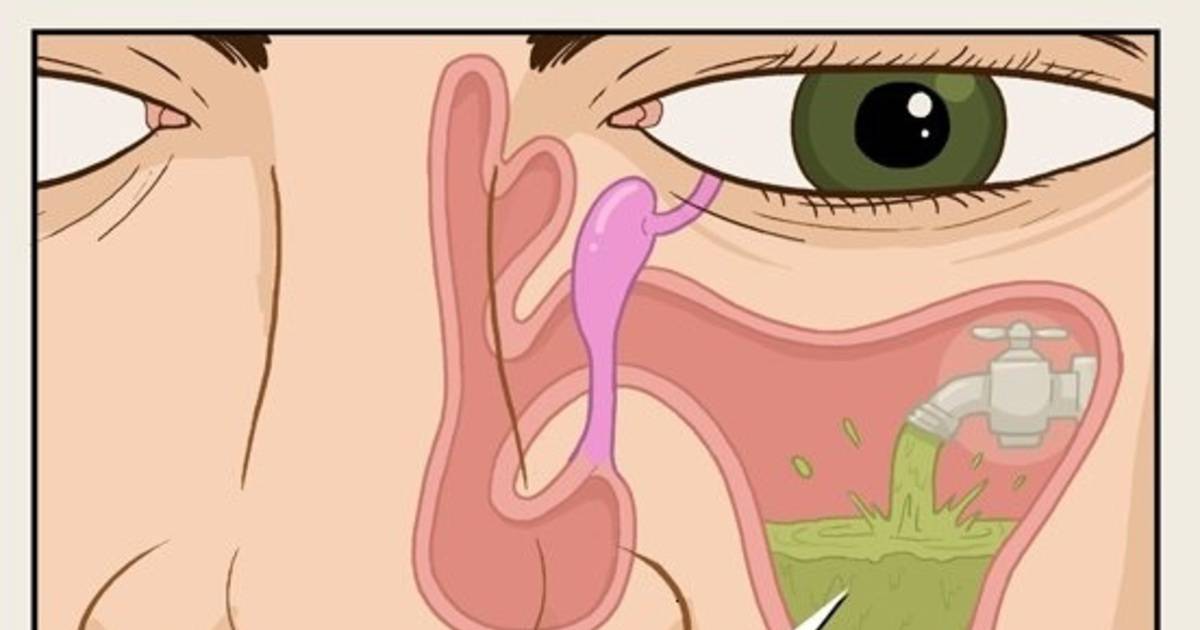 Эндоскопия носа и носоглотки - золотой стандарт диагностики