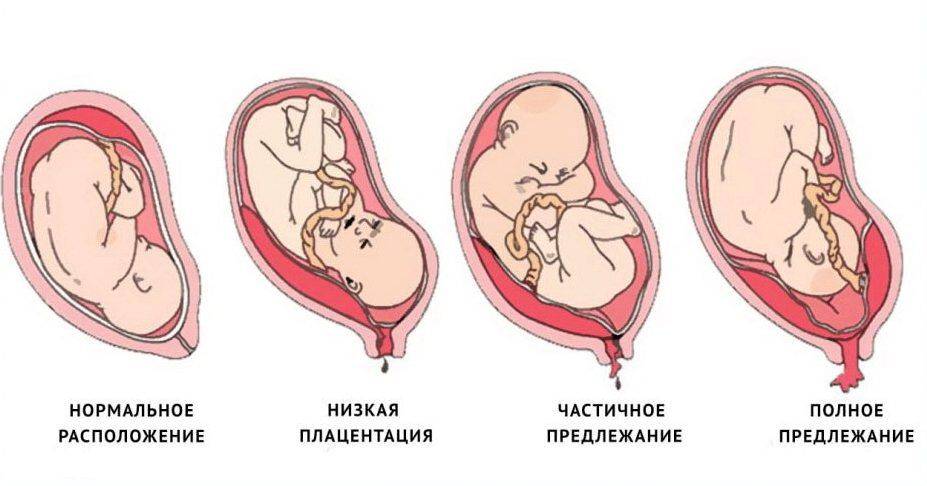 Низкое расположение плода в матке при беременности: в чем причина и может ли он подняться?