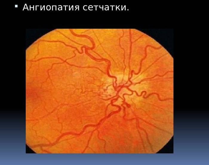 Макулодистрофия сетчатки глаза: причины и лечение