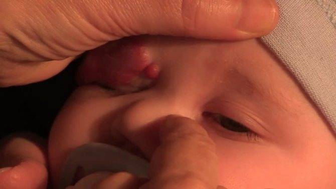 Массаж слёзного канала у новорожденного, мнение е. о. комаровского