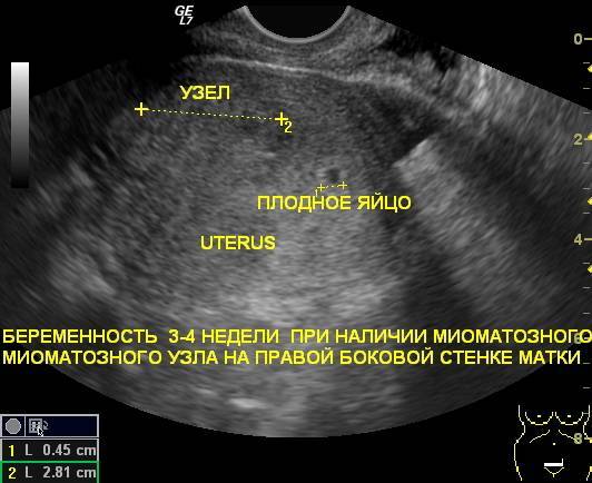 Можно ли перепутать кисту с беременностью: сравнение симптомов | kazandoctor.ru
