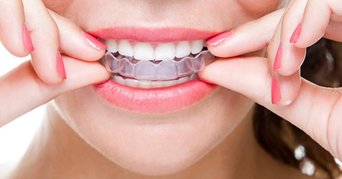 Выравнивание зубов: основные виды | компетентно о здоровье на ilive