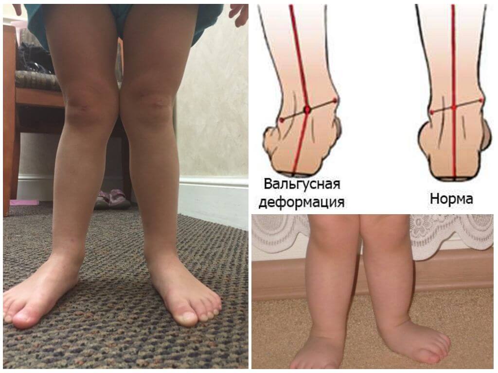 Вальгусная деформация стопы у детей (плосковальгусная) с фото: способы лечения искривления