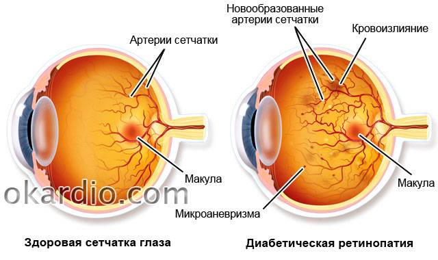 Заболевания сетчатки глаз - симптомы, лечение