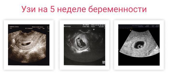 Фото узи ребенка на разных сроках беременности