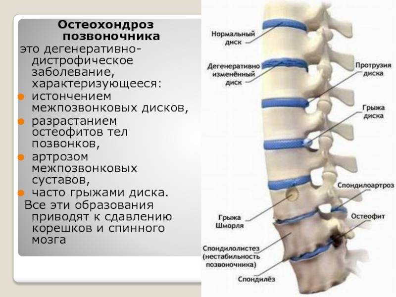 Дегенеративные изменения грудного позвоночника. Дегенеративные изменения шейного отдела. С остеохондрозом берут в армию. Дорсалгия позвоночника. Берут ли в армию с остеохондрозом поясничного отдела.