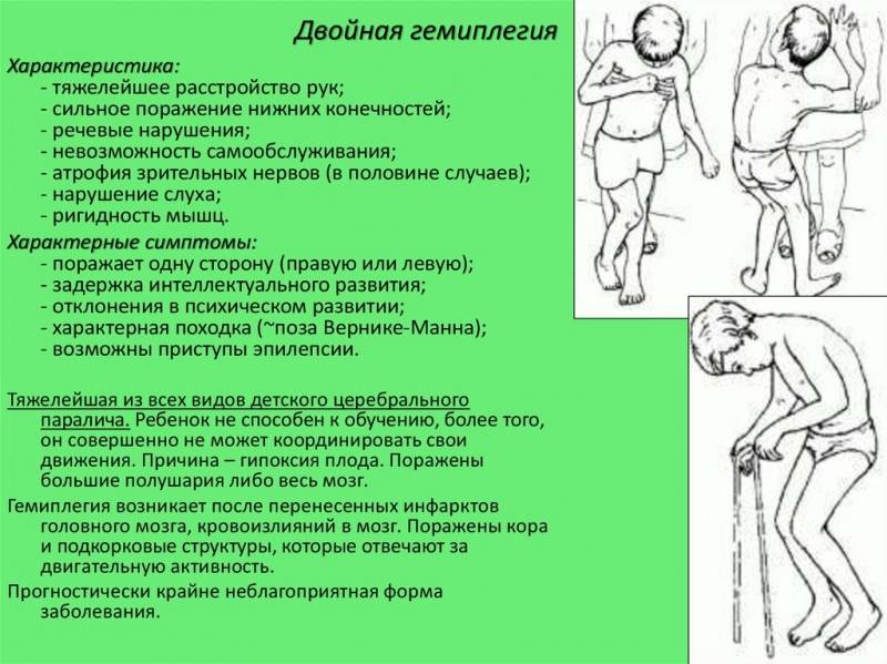 Детский церебральный паралич (дцп): симптомы, причины, реабилитация – напоправку – напоправку