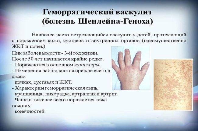 Диагностика и лечение геморрагического васкулита современном госпитале в москве