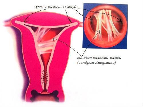 Абляция эндометрия матки