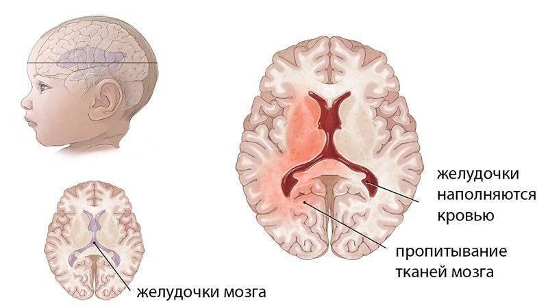 Отёк и набухание головного мозга — большая медицинская энциклопедия