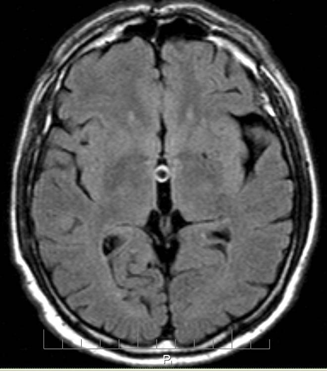 Киста головного мозга у новорожденного (в голове): субэпендимальная, сосудистая