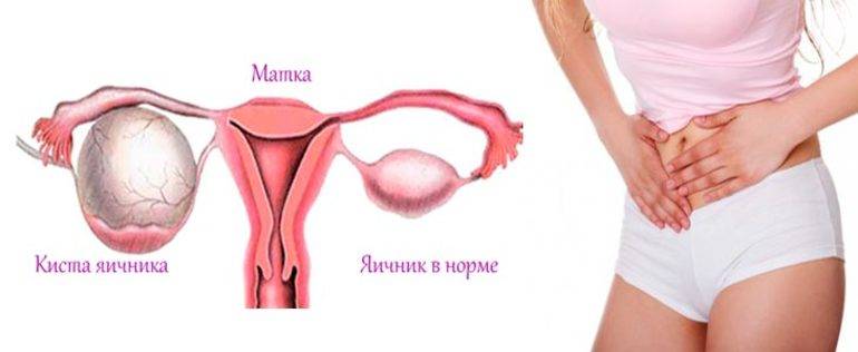 Аденомиоз матки: что за диагноз, симптомы у женщин разного возраста, причины возникновения, лечение - причины, диагностика и лечение