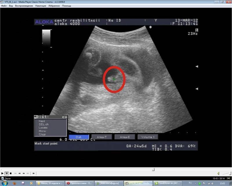 Киста яичника при беременности | симптомы и лечение кисты яичника при беременности | компетентно о здоровье на ilive