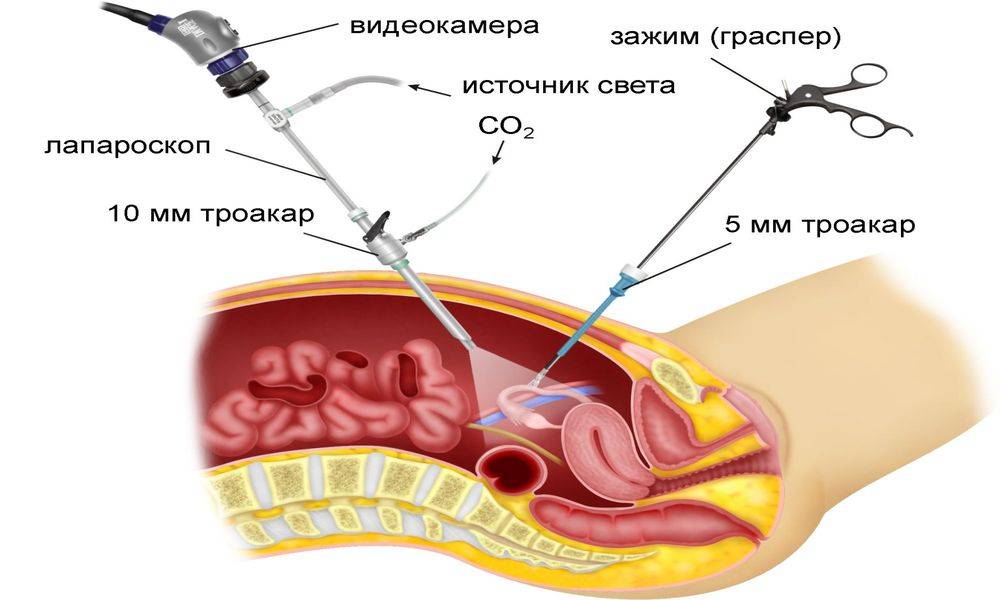 Спайки и их лечение. экстракорпоральное оплодотворение или просто эко.