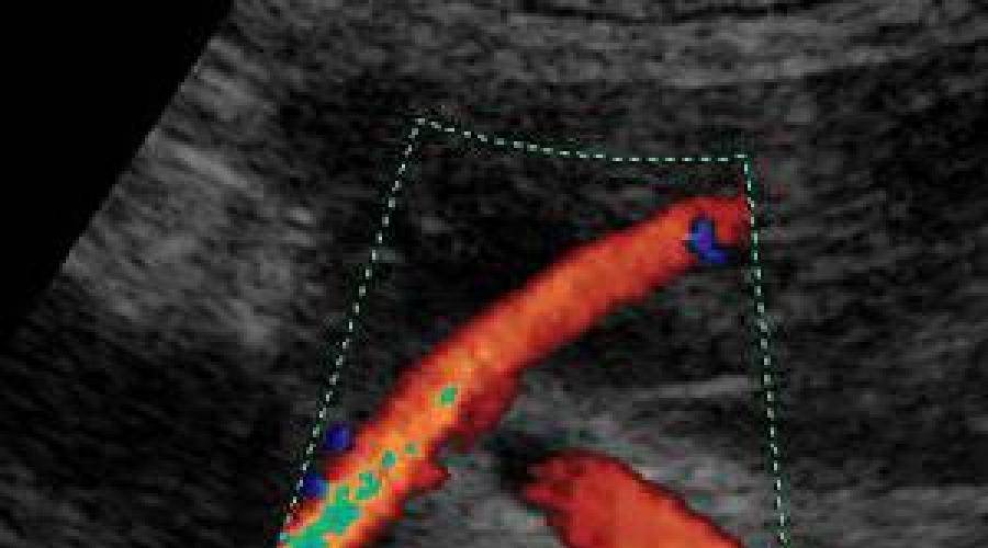 Доплер это во время. Допплерометрия сосудов матки. Допплер сосудов матки норма. Допплер маточных артерий. УЗИ допплерометрия сосудов матки.