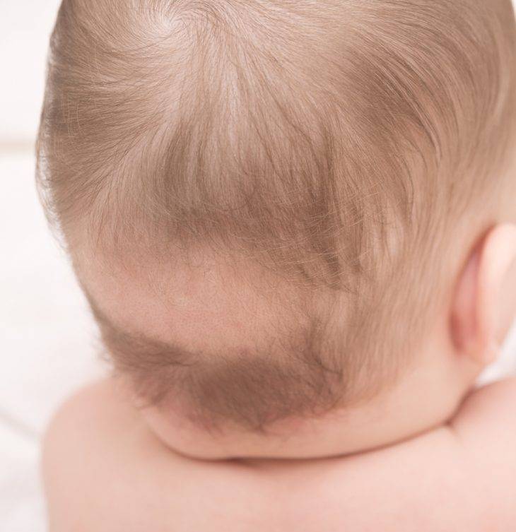 Выпадение волос у детей: большая проблема малышей