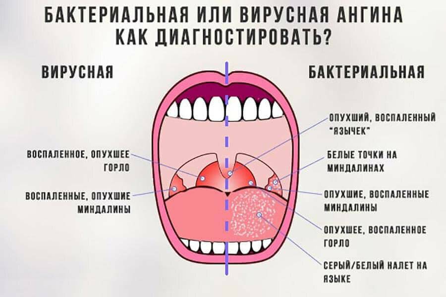 Острый тонзиллит (ангина) у детей, симптомы и лечение