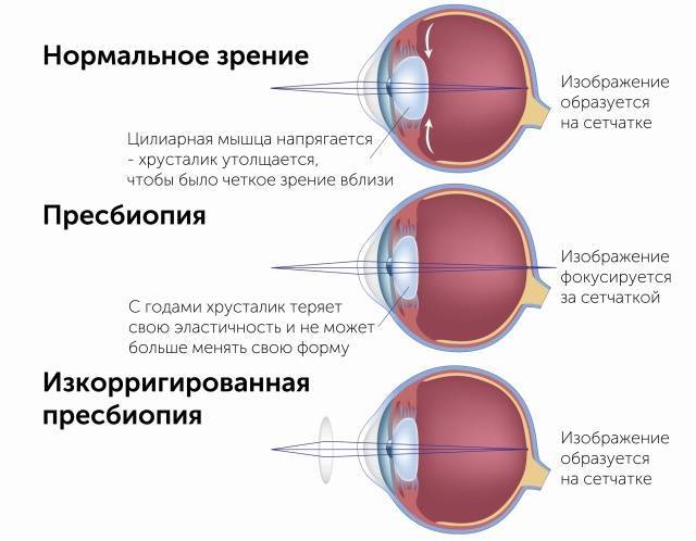 Упражнения для глаз при косоглазии - энциклопедия ochkov.net