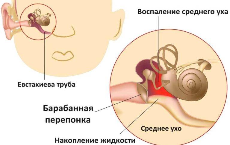 Заложенность уха у взрослых и детей: диагностика, как предотвратить | компетентно о здоровье на ilive