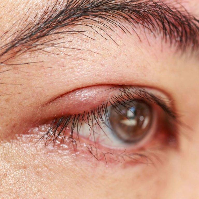 Ячмень на глазу — что это такое, симптомы, причины. как быстро вылечить ячмень на глазу