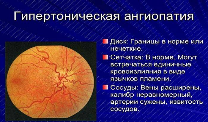 Сосудистые заболевания оболочки глаз, методы лечения