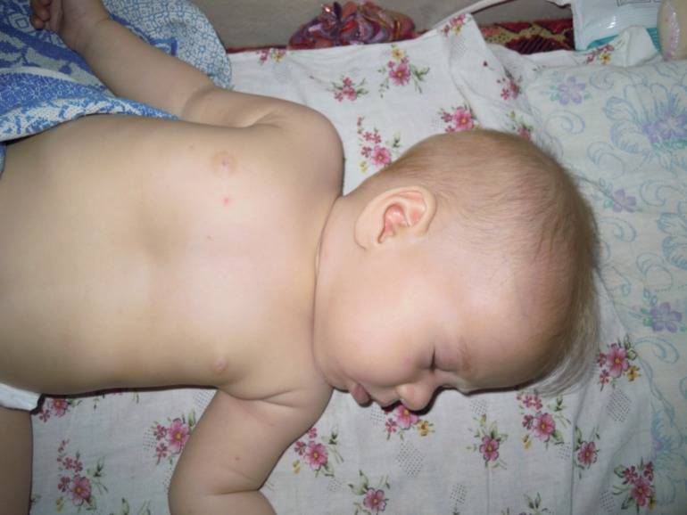 Впалая грудная клетка у ребенка — причина и лечение