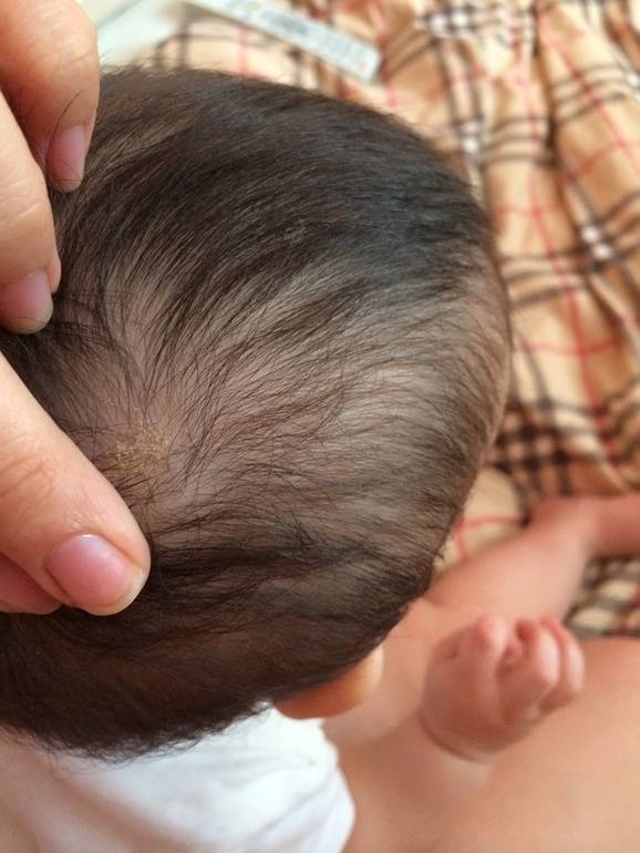 У ребенка плохо растут волосы, выпадают: причины, витамины (Комаровский)