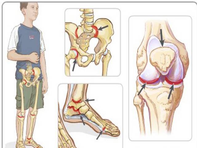 Причины подагры. симптомы и лечение приступа подагрического артрита