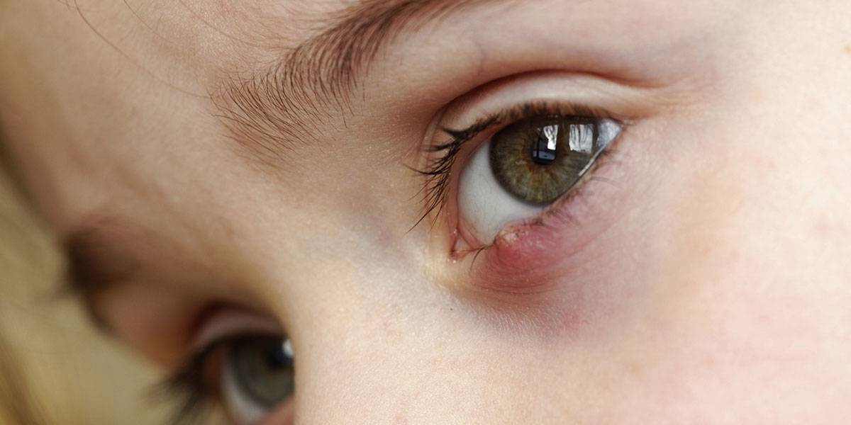 Ячмень на веке глаза: причины появления, лечение, вскрытие ячменя.
