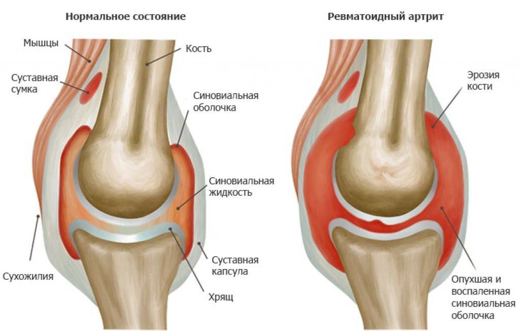Ревматоидный артрит коленного сустава: симптомы и лечение