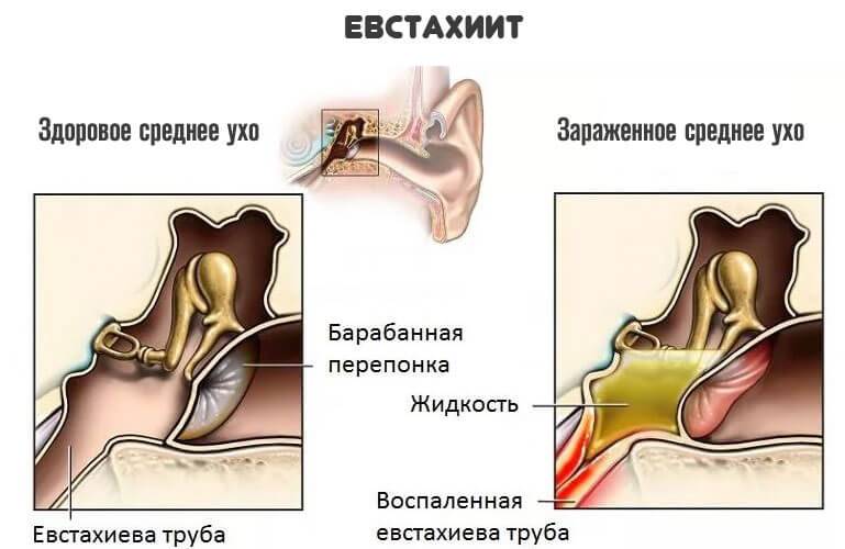 Евстахиит (тубоотит) — лечение острого тубоотита в цэлт