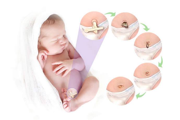 Инструкция по уходу и обработке пупка у младенца