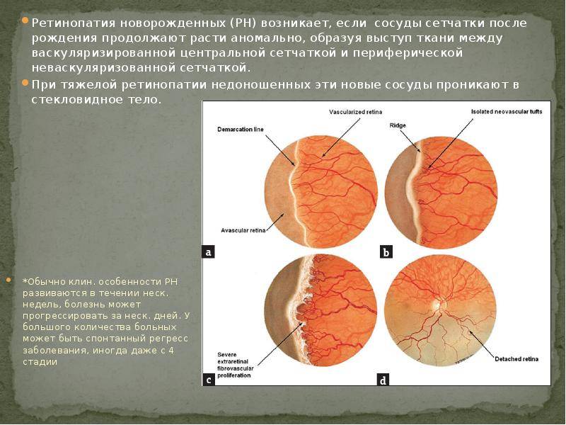 Ретинопатия недоношенных | компетентно о здоровье на ilive